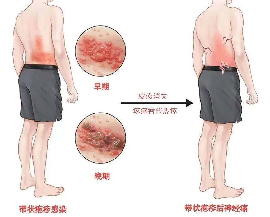一旦感染终身携带<strong></p>
<p>全球交易货币</strong>！深圳疾控提醒：这4类人要注意