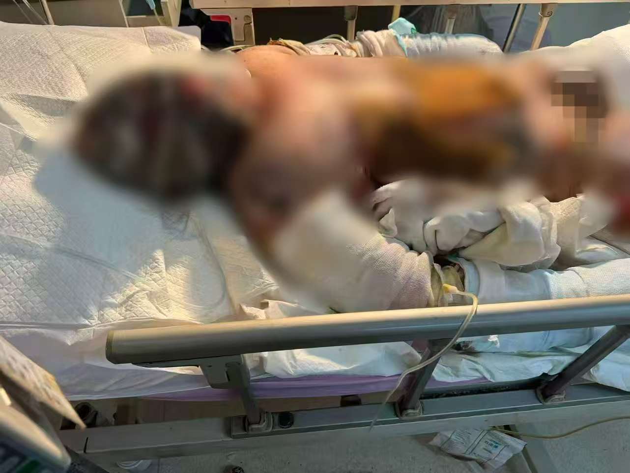 父子在哈尔滨一亲戚公司上班遇爆炸全身烧伤<strong></p>
<p>BNB交易所</strong>,治疗花费近百万公司拒赔偿?亲戚回应