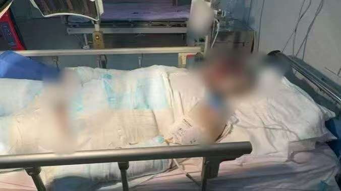 父子在哈尔滨一亲戚公司上班遇爆炸全身烧伤<strong></p>
<p>BNB交易所</strong>,治疗花费近百万公司拒赔偿?亲戚回应