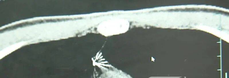 17岁小伙参军体检发现胸腔内有根5cm缝衣针<strong></p>
<p>古德币</strong>，父母回忆或是1岁时扎入，取出时已锈迹斑斑