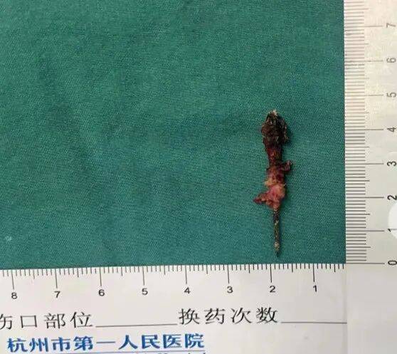 17岁小伙参军体检发现胸腔内有根5cm缝衣针<strong></p>
<p>古德币</strong>，父母回忆或是1岁时扎入，取出时已锈迹斑斑