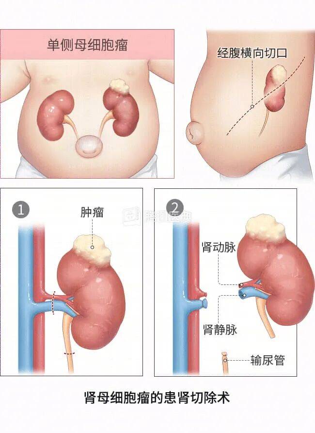 “感觉天塌了”!深圳女孩5岁患癌,爸妈决定:为她冻存卵巢组织