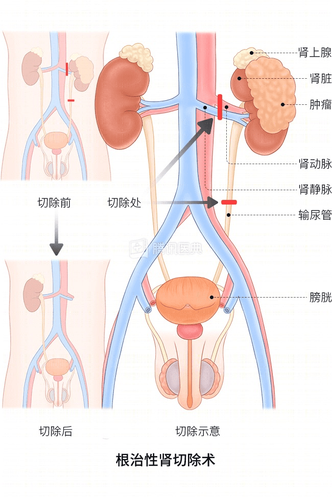 “感觉天塌了”!深圳女孩5岁患癌<strong></p>
<p>雷速币</strong>,爸妈决定:为她冻存卵巢组织